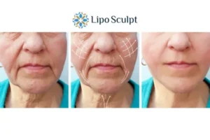 Explaining Morpheus8 And What It Can Do For You 3 Boost your confidence with Morpheus8 Cheshunt call our team today!